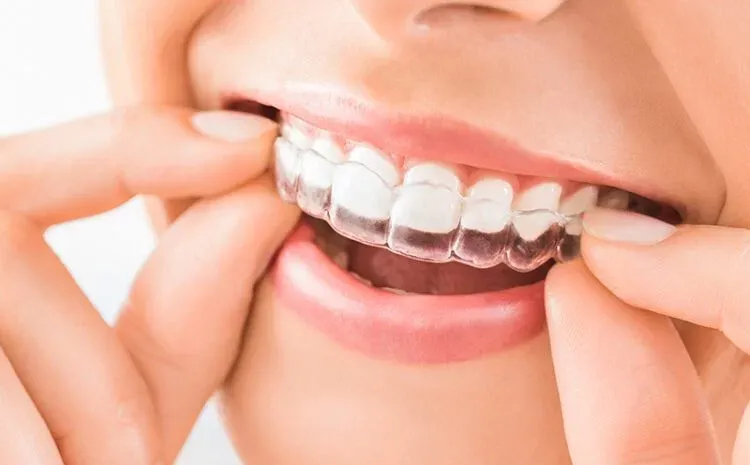 dentalaligners3 750x465