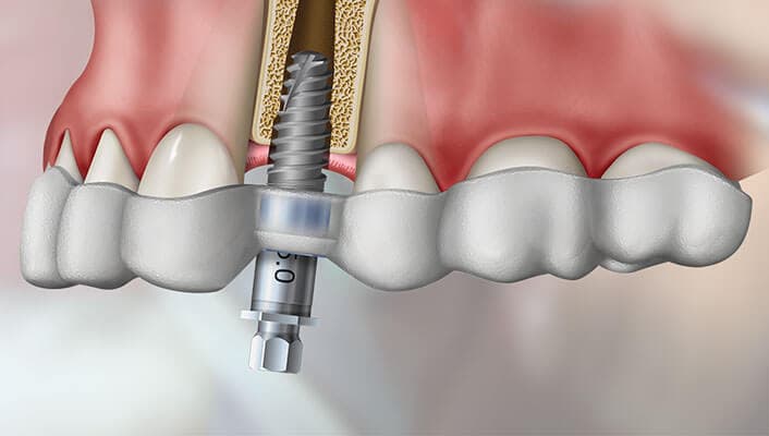 surgically guided dental implant surgery