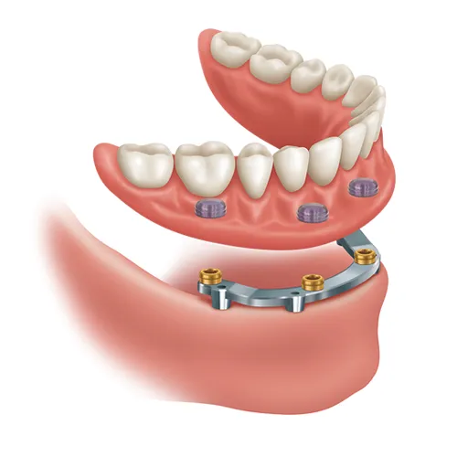 za removable attachment legacy loc overdenture bar