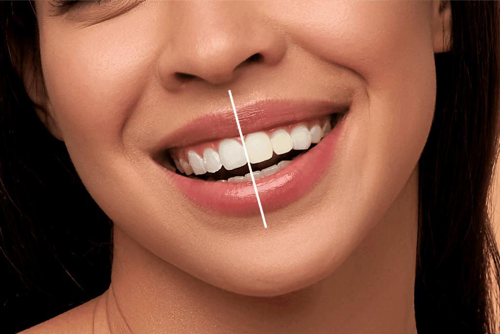 whitening 1024x684
