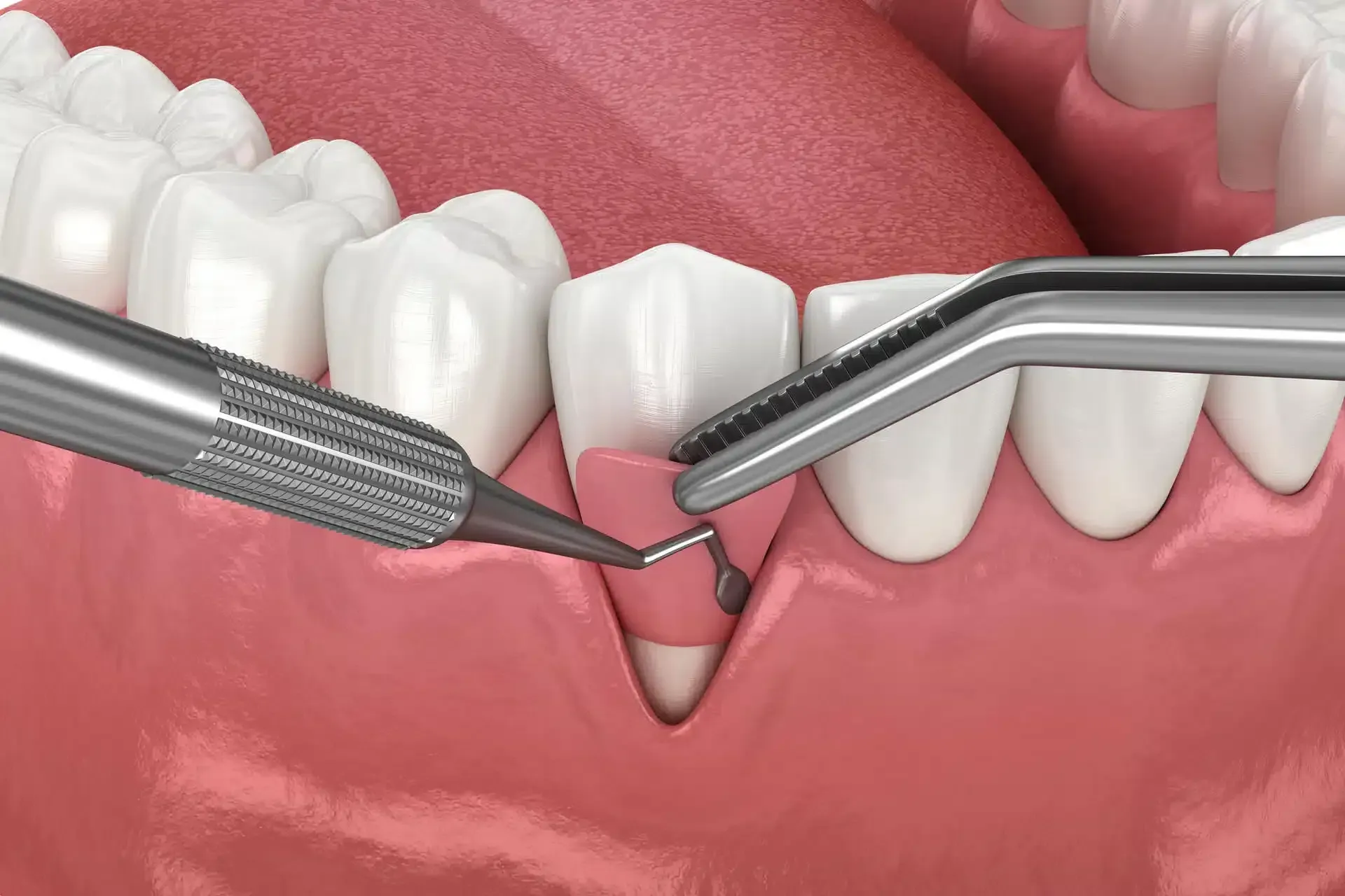 Illustration on gum graft surgery