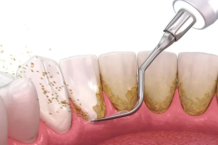 deep teeth cleaning procedure