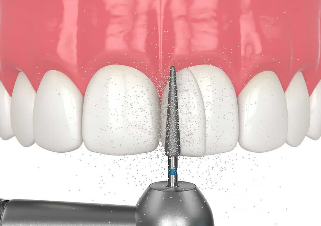 dental bonding 1024x721