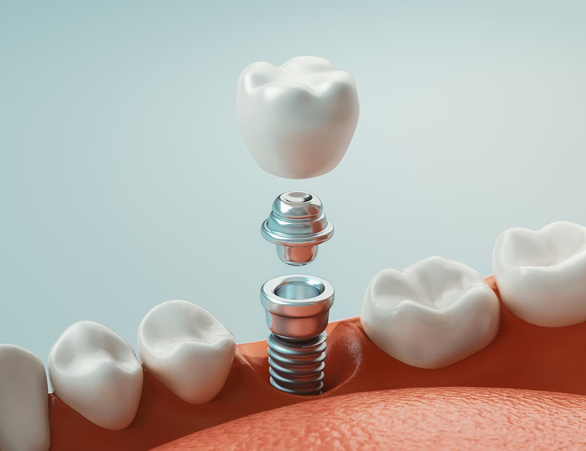 digitally generated image dental implant surgery