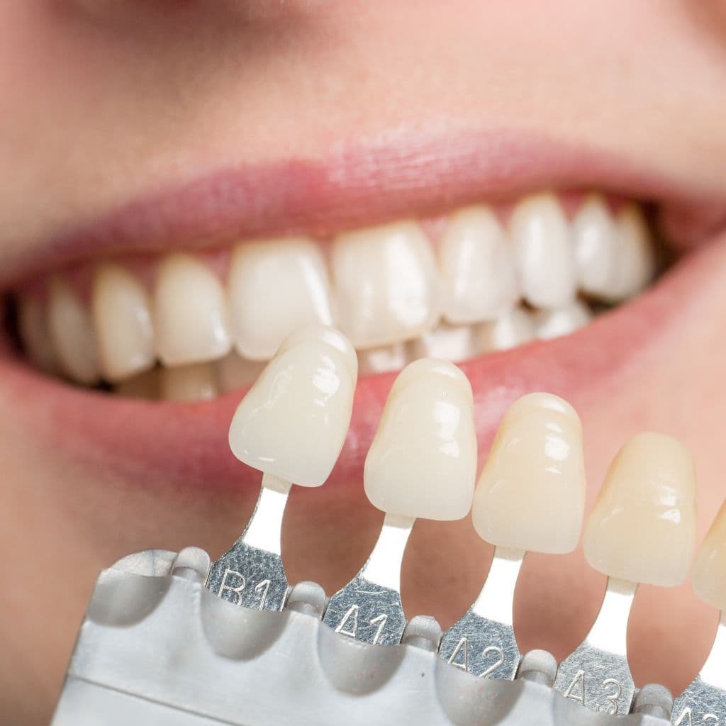 dental veneers